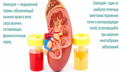 Наличие в моче крови - главный симптом геморрагического цистита