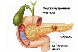 Схема рака поджелудочной железы