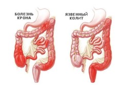 Болезнь Крона - причина увеличения поджелудочной железы