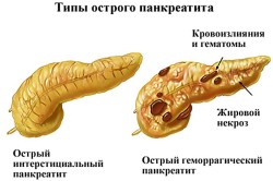 Острый панкреатит - причина увеличения поджелудочной