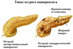 Типы острого панкреатита