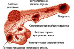 Опухоли поджелудочной железы