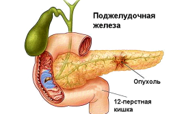 Опухоль поджелудочной железы