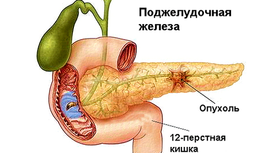 Схема опухоли поджелудочной железы Схема опухоли поджелудочной железы