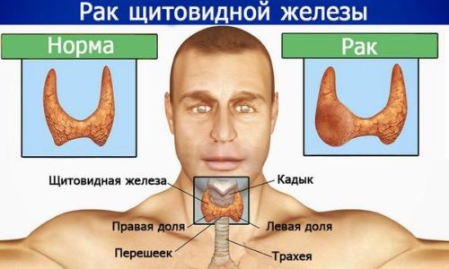 Папиллярный рак щитовидной железы прогноз после операции сколько лет жизни