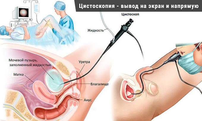 Для полной верификации диагноза используется цистоскопия. Это процедура, которая заключается в введении цистоскопа в полость мочевого пузыря для детального осмотра и взятия кусочка на биопсию
