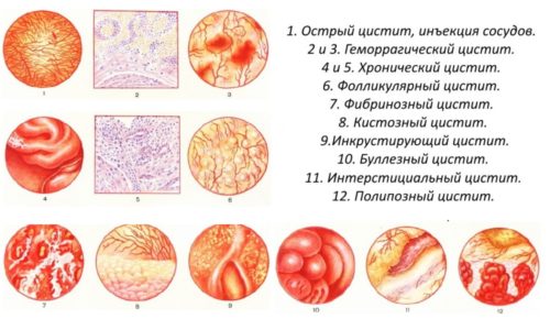 Циститы бывают инфекционные или неинфекционные, отличаются они способами попадания микроорганизмов и вирусов в мочевой пузырь или вызываются другими факторами