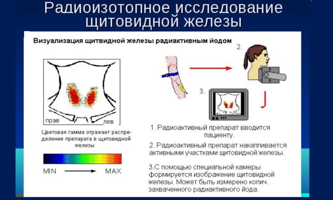 Радиоизотопные сканирование проводится для диагностики узлов на щитовидной железе