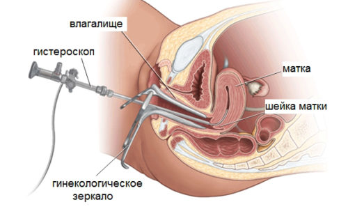 Выскабливание проводится при нарушениях в менструальных циклах и для остановки кровотечений