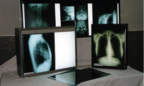 Негатоскоп представляет собой устройство для просмотра рентгенографических снимков с целью диагностирования и наблюдения за состоянием органов малого таза у женщин
