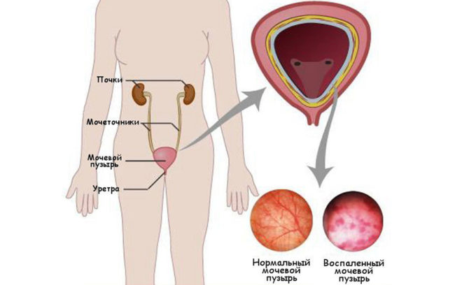 Уретра у женщин короткая, из-за чего болезнетворные бактерии быстро достигают мочевого пузыря, провоцируя его воспаление